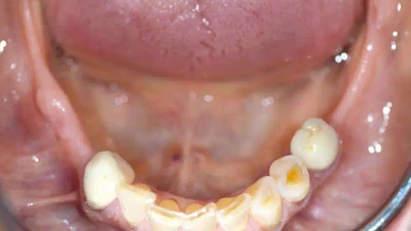 Block augmentation with maxgraft® in the mandible