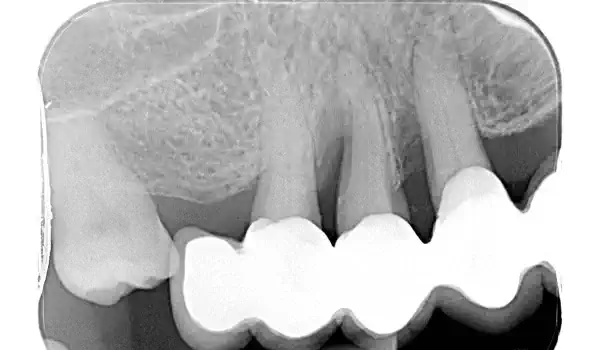 Image for case GTR for the treatment of a deep three-dimensional intrabony defect using cerabone®, collprotect® membrane and Straumann® Emdogain®
