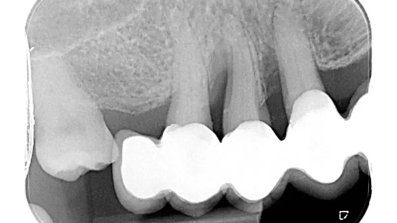GTR for the treatment of a deep three-dimensional intrabony defect using cerabone®, collprotect® membrane and Straumann® Emdogain®