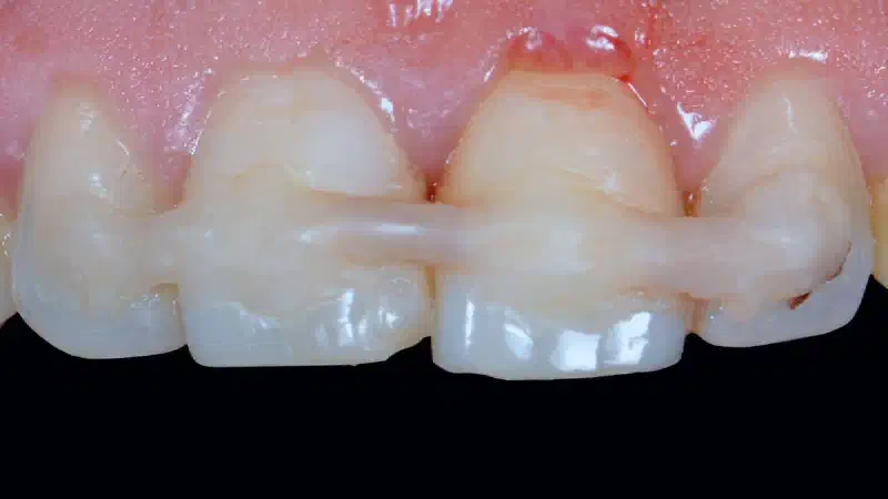 Immediate implant placement in the aesthetic zone – Dr Jose Manuel Abarca
