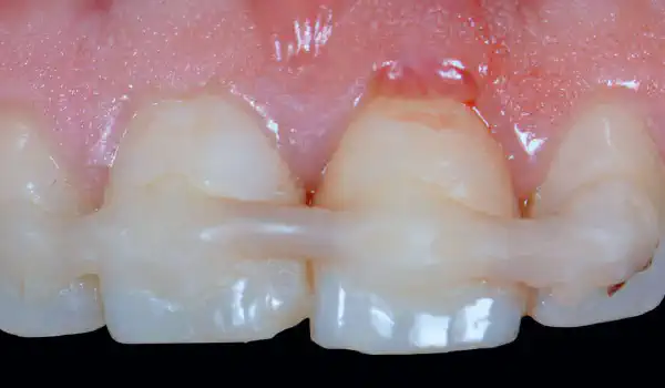 Image for case Immediate implant placement in the aesthetic zone – Dr Jose Manuel Abarca