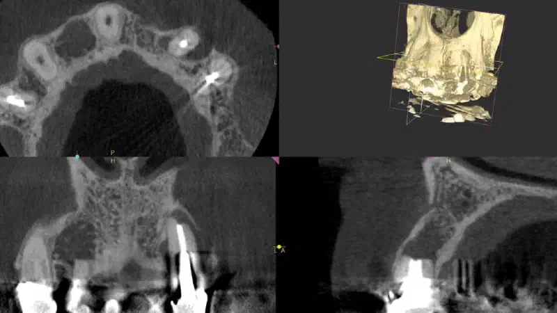 Augmentation in the esthetic zone with maxgraft® bonebuilder