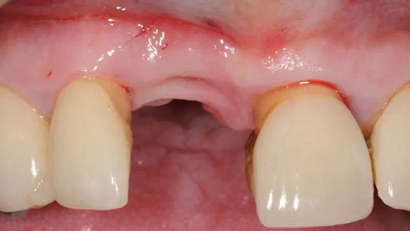 Restoration of buccal bone lamella in aesthetic zone with maxgraft® bonering