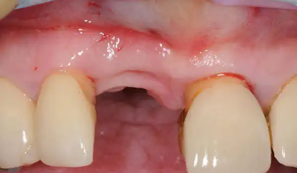 Image for case Restoration of buccal bone lamella in aesthetic zone with maxgraft® bonering