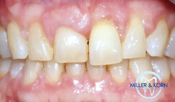 Image for case Immediate implant placement and correction of horizontal and vertical bone loss using an allograft bone ring, cerabone® and Jason® membrane