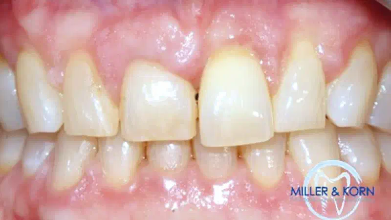 Immediate implant placement and correction of horizontal and vertical bone loss using an allograft bone ring, cerabone® and Jason® membrane