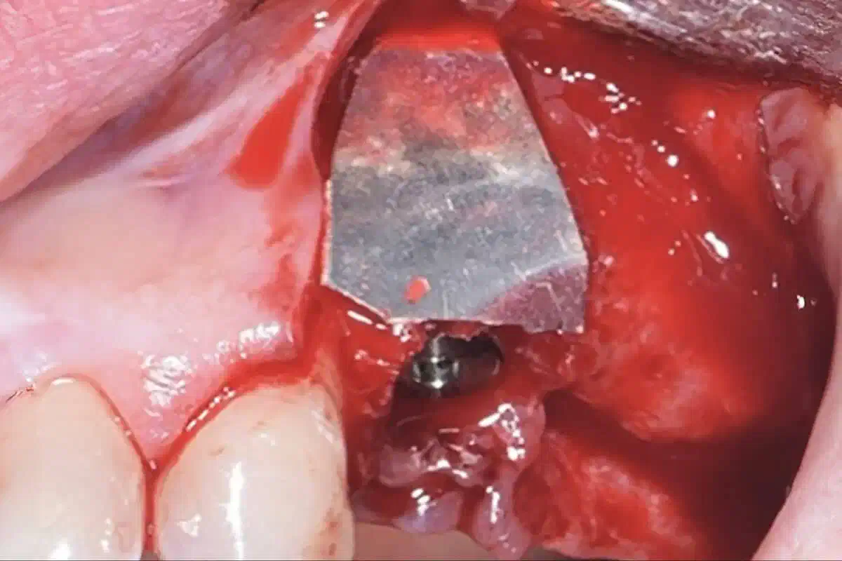 Shield Technique with NOVAMag® membrane