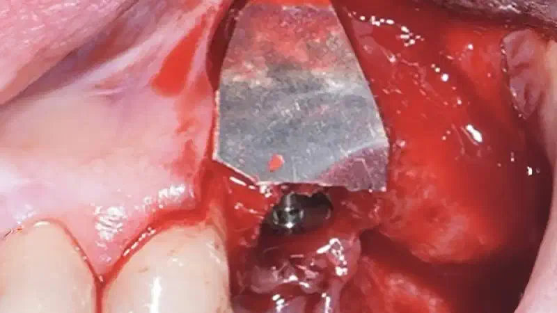 Shield Technique with NOVAMag® membrane
