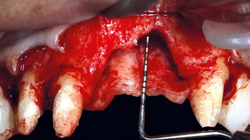 Regeneration of a 9 mm vertical bone defect with cerabone®, autologous bone and S-PRF