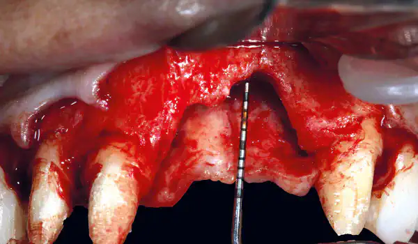 Image for case Regeneration of a 9 mm vertical bone defect with cerabone®, autologous bone and S-PRF