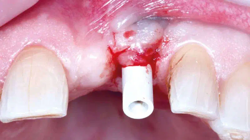 Bone augmentation in the aesthetic zone with maxgraft® bonering