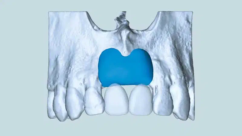 Ridge augmentation in the maxilla with maxgraft® bonebuilder in the aesthetic zone