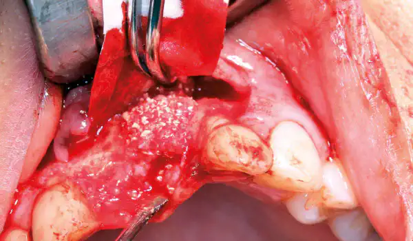 Image for case GBR in the aesthetic zone with cerabone® and maxgraft®