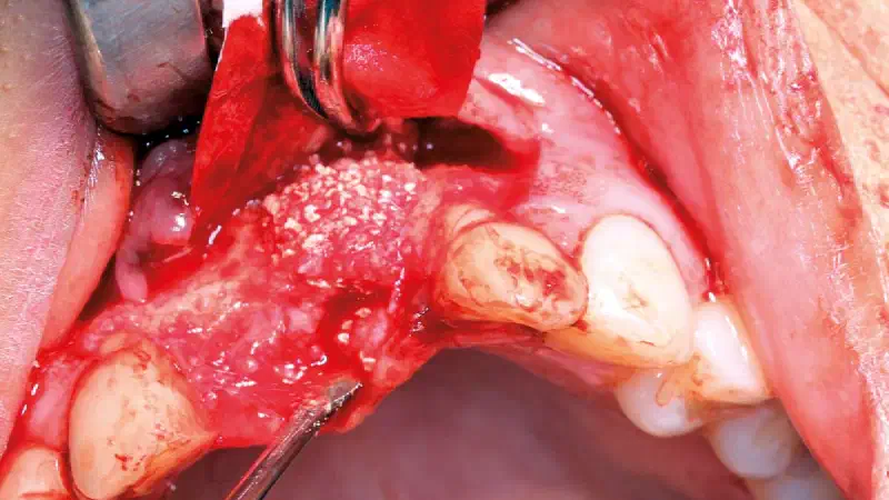 GBR in the aesthetic zone with cerabone® and maxgraft®
