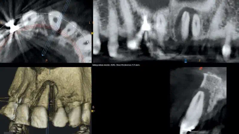GBR with maxgraft® and Jason® membrane with 3 year follow up