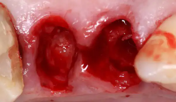 Image for case Immediate implantation with maxresorb® inject