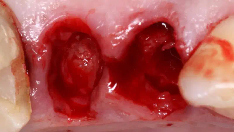 Immediate implantation with maxresorb® inject