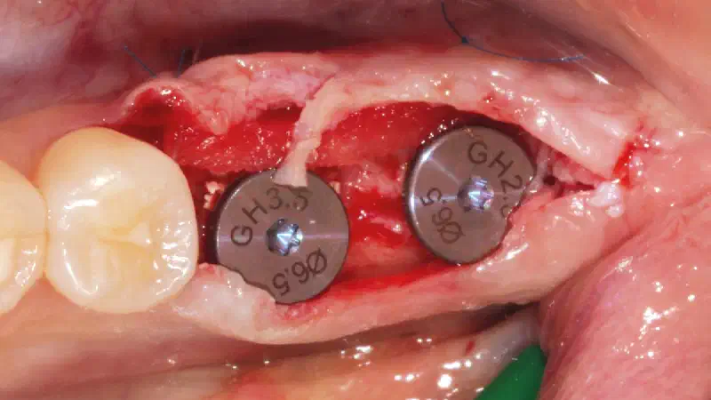 Horizontal Management of Peri-Implant Soft Tissue Deficiency with mucoderm®