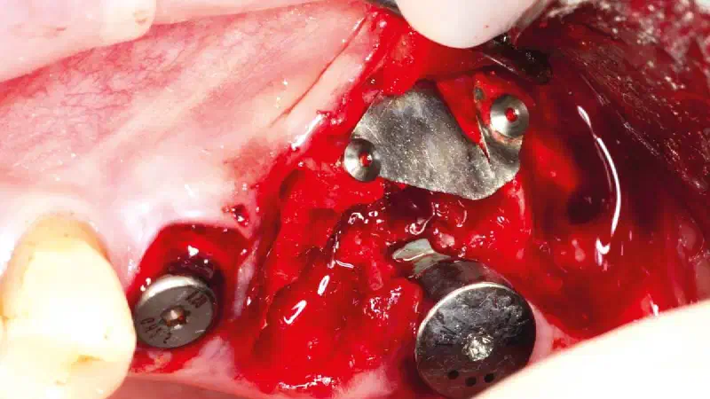 Immediate implant placement in the maxilla with NOVAMag® membrane and maxgraft® granules
