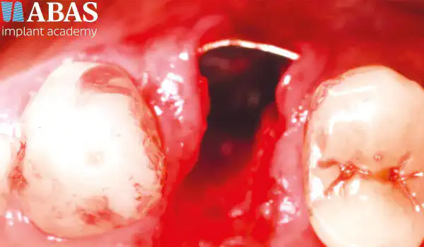 Image for case Clinical management of buccal bone loss in the anterior zone with NOVAMag® SHIELD and maxgraft® granules
