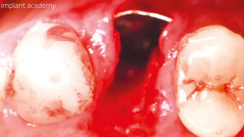Clinical management of buccal bone loss in the anterior zone with NOVAMag® SHIELD and maxgraft® granules