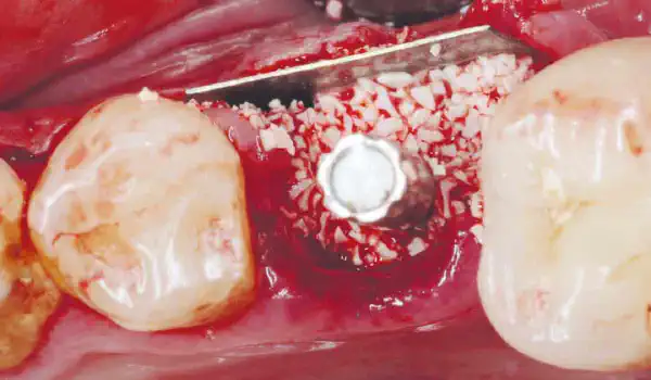 Image for case Shield Technique with immediate implant placement – Study in collaboration with the Faculty of Dental Medicine, Lebanese University Lebanon University