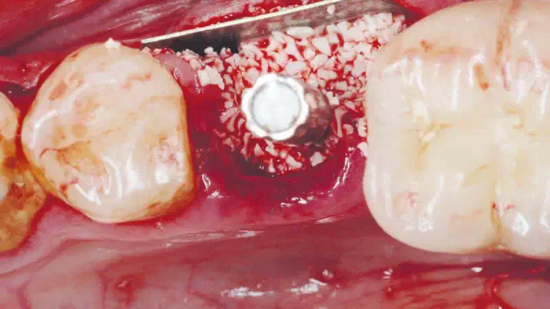 Shield Technique with immediate implant placement – Study in collaboration with the Faculty of Dental Medicine, Lebanese University Lebanon University