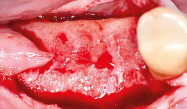 Image for case Effective Socket Grafting with cancellous maxgraft® +HyA and Jason® membrane
