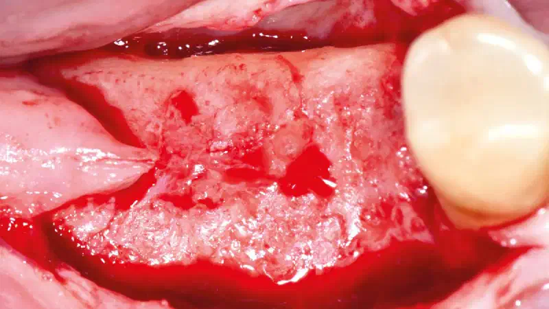 Effective Socket Grafting with cancellous maxgraft® +HyA and Jason® membrane
