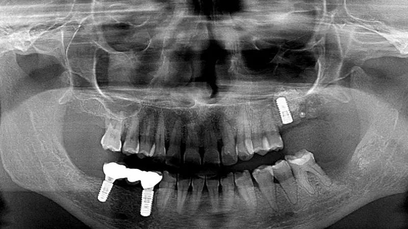 One stage sinus floor augmentation – Six-year follow-up