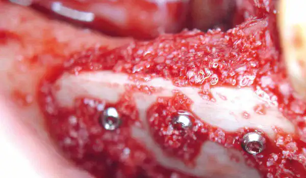 Image for case mucoderm® for regeneration following removal of an odontogenic fibroma
