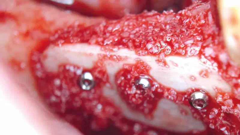 mucoderm® for regeneration following removal of an odontogenic fibroma