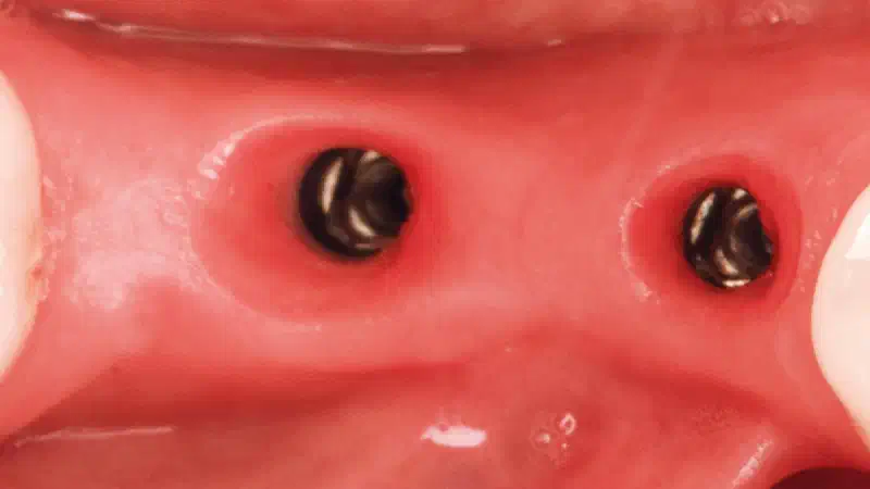 Peri-implant Soft Tissue Phenotype Modification Using Xenogeneic Collagen Matrix