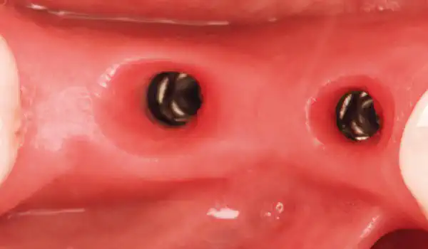 Image for case Peri-implant Soft Tissue Phenotype Modification Using Xenogeneic Collagen Matrix