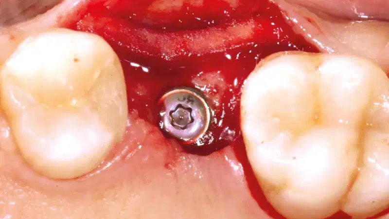 Management of Peri-Implant Soft Tissue Deficiency with mucoderm®: 10 years of stability