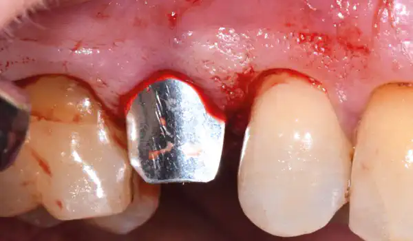 Image for case Regeneration of a compromised extraction socket with NOVAMag® SHIELD