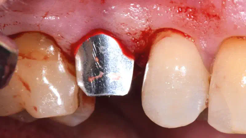 Regeneration of a compromised extraction socket with NOVAMag® SHIELD
