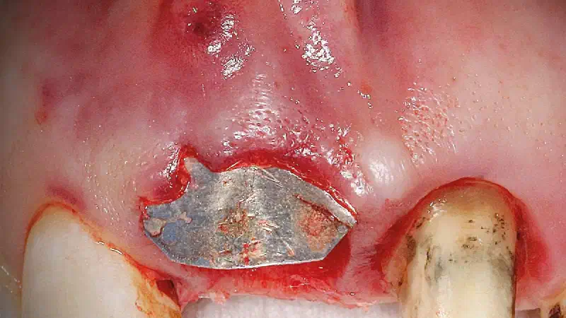 Immediate Implant Placement with Buccal Wall Reconstruction Using NOVAMag® SHIELD and cerabone® +HyA