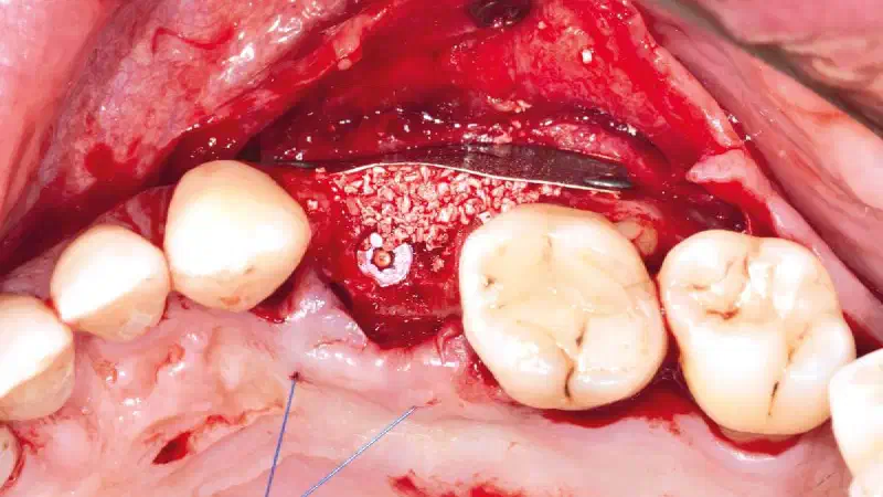 Alveolar ridge preservation with the Shield technique in the maxilla