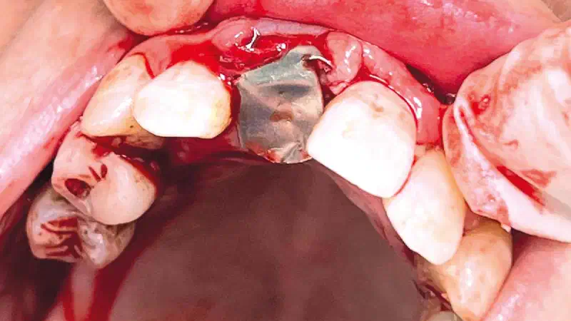 Immediate implant placement with the Shield Technique and NOVAMag® SHIELD