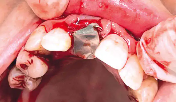 Image for case Immediate implant placement with the Shield Technique and NOVAMag® SHIELD