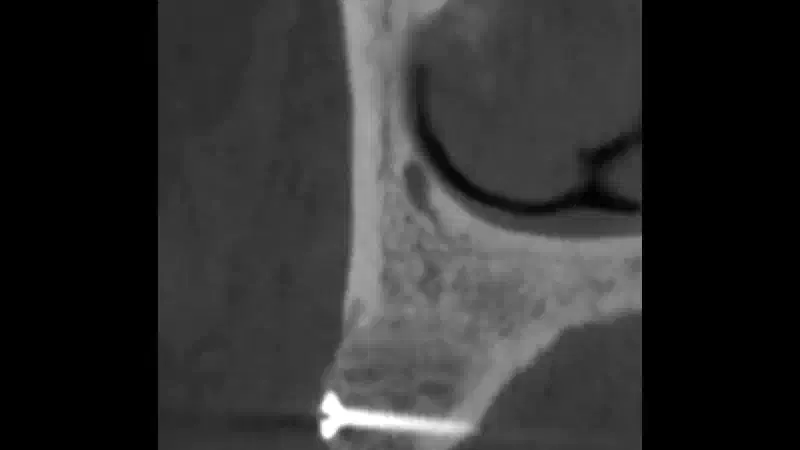 Lateral block augmentation in the posterior maxilla with cancellous maxgraft® block