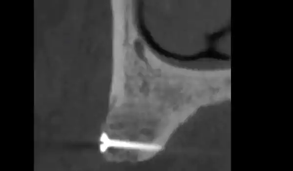 Image for case Lateral block augmentation in the posterior maxilla with cancellous maxgraft® block