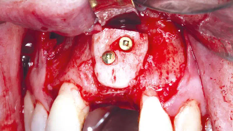 Block grafting in the aesthetic zone with maxgraft®, Jason® membrane and cerabone®
