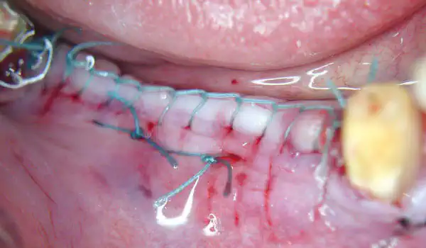 Image for case Simultaneous GBR and implantation, using maxgraft® granules and autologous bone