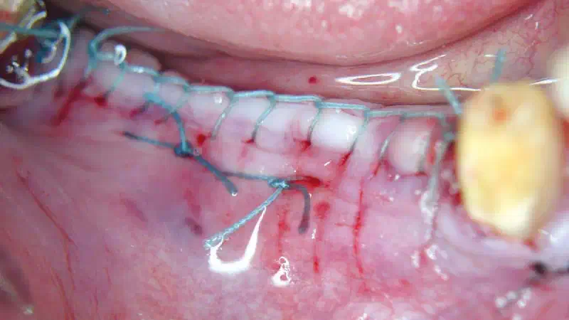 Simultaneous GBR and implantation, using maxgraft® granules and autologous bone