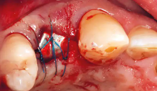 Image for case Predictable socket preservation with collacone® and NOVAMag® SHIELD