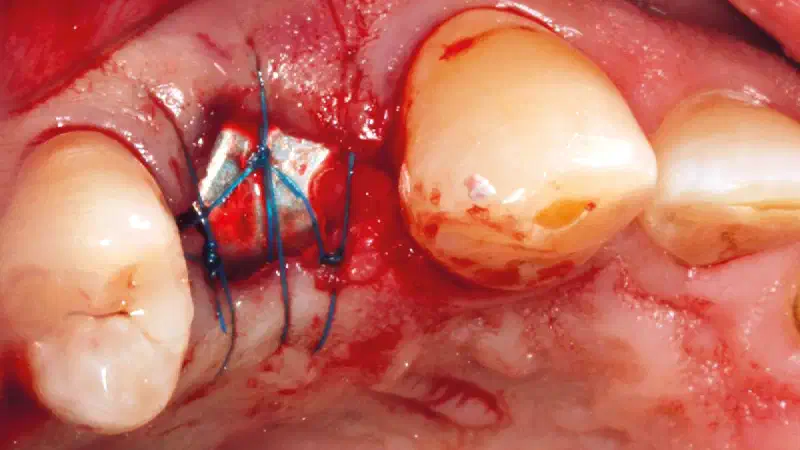 Predictable socket preservation with collacone® and NOVAMag® SHIELD