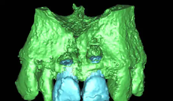 Image for case Ridge preservation with cerabone® & Jason® membrane