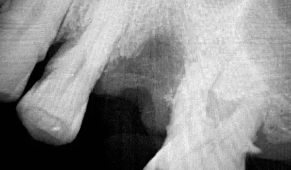 Image for case Ridge Preservation with NOVAMag® SHIELD and collacone® in a periodontally compromised patient